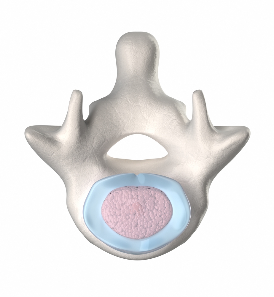 Can L4 and L5 spinal stenosis be cured?