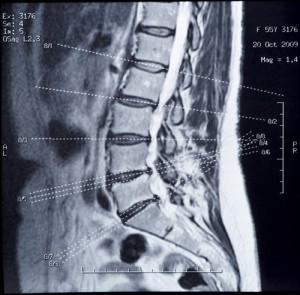 MRI low back pain Tulsa Prolotherapy PRP