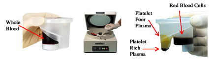 Tulsa Platelet Rich Plasma PRP Prolotherapy Device