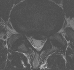 low back herniated disk before prolotherapy transverse