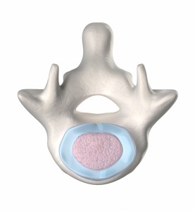 vertebrae disk nucleus prolotherapy
