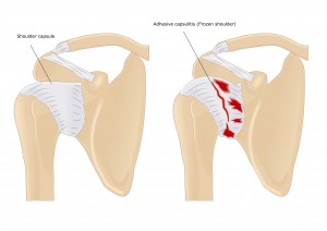 prolotherapy for adhesive capsulitis (frozen shoulder)